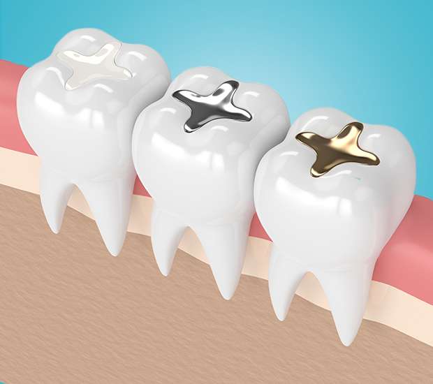 Brooklyn Tooth Colored Fillings