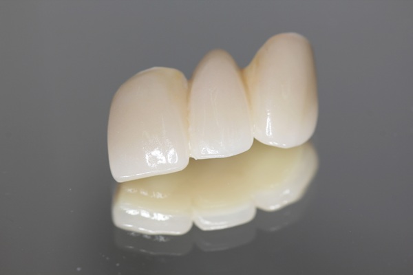 Dental Bridge Guide: How It Works, Pros/Cons, And How Long It Lasts