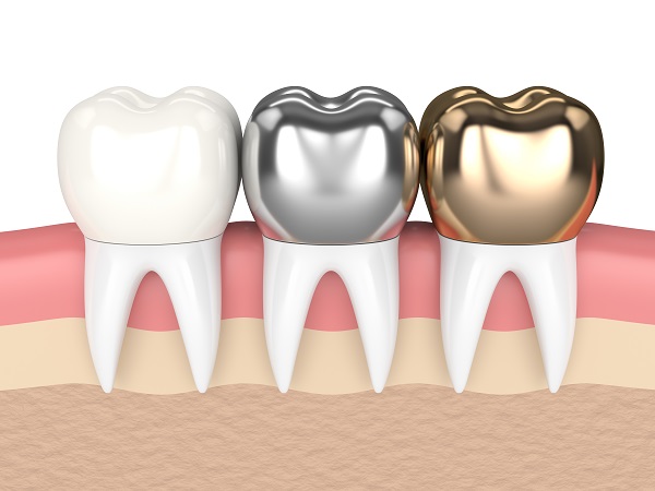 A Cosmetic Dentist Discusses Dental Crown Options