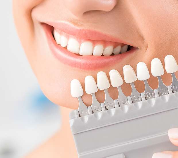 Brooklyn Veneers