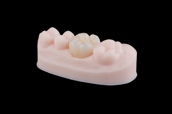 Dental Fillings Vs  Dental Crowns: Which Is Better For A Damaged Tooth?