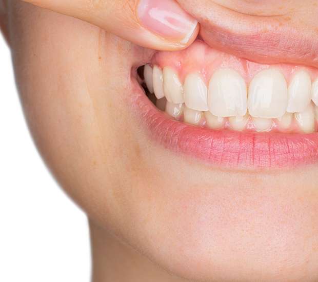 Brooklyn Gum Disease